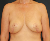 Feel Beautiful - Breast Lift 310 - After Photo
